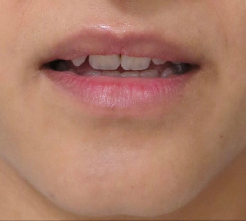 Lip Augmentation Before & After Gallery - Patient 122909221 - Image 1