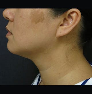 Non-Surgical Neck Lift Before & After Gallery - Patient 122909220 - Image 4