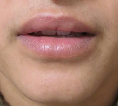 Lip Augmentation Before & After Gallery - Patient 122909221 - Image 2