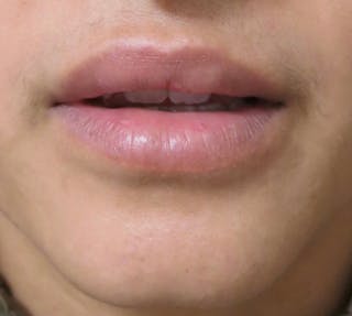 Lip Augmentation Before & After Gallery - Patient 122909221 - Image 2