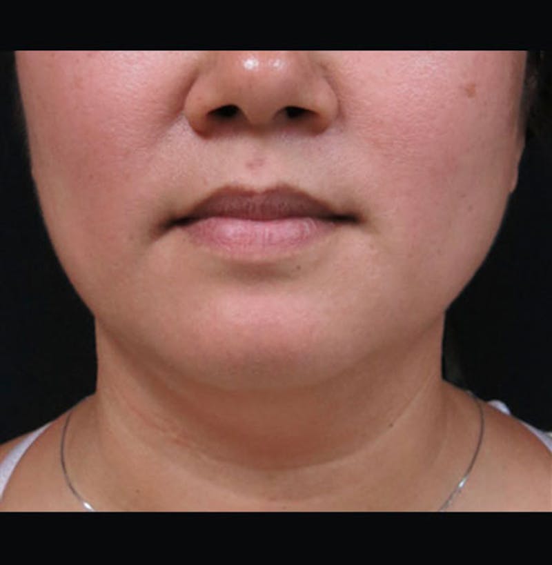 Non-Surgical Neck Lift Before & After Gallery - Patient 122909220 - Image 5