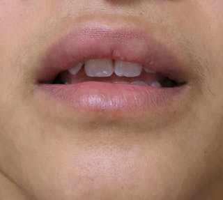 Lip Augmentation Before & After Gallery - Patient 122909221 - Image 4