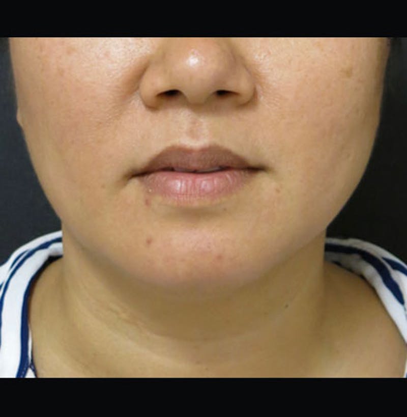Non-Surgical Neck Lift Before & After Gallery - Patient 122909220 - Image 6