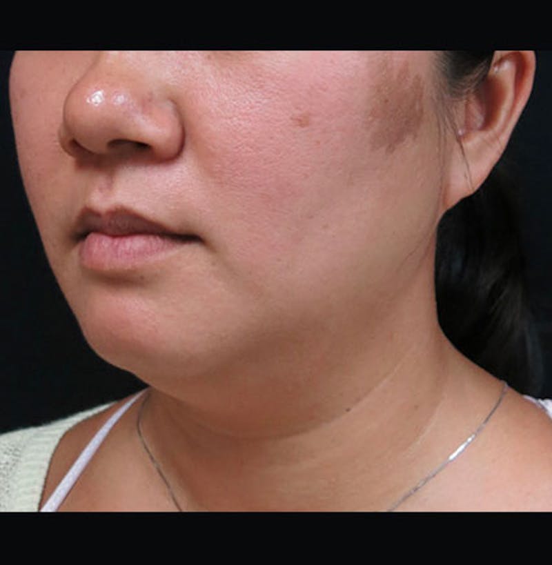 Non-Surgical Neck Lift Before & After Gallery - Patient 122909220 - Image 7