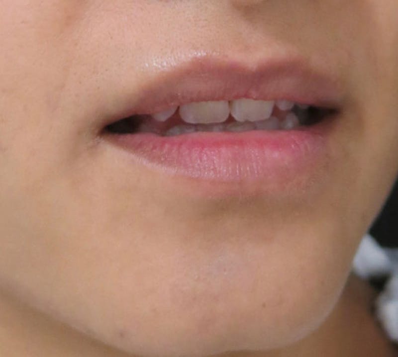 Lip Augmentation Before & After Gallery - Patient 122909221 - Image 5