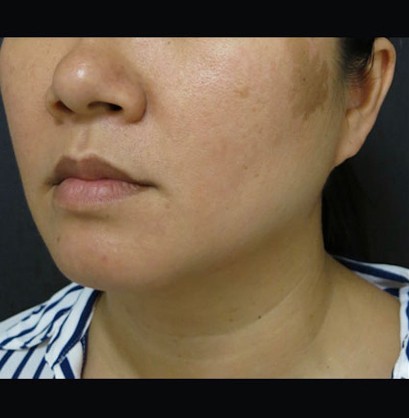 Non-Surgical Neck Lift Before & After Gallery - Patient 122909220 - Image 8