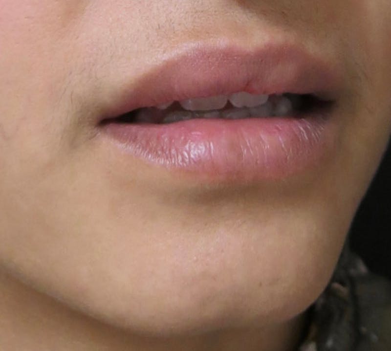 Lip Augmentation Before & After Gallery - Patient 122909221 - Image 6