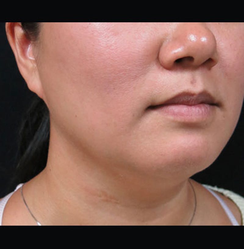 Non-Surgical Neck Lift Before & After Gallery - Patient 122909220 - Image 9