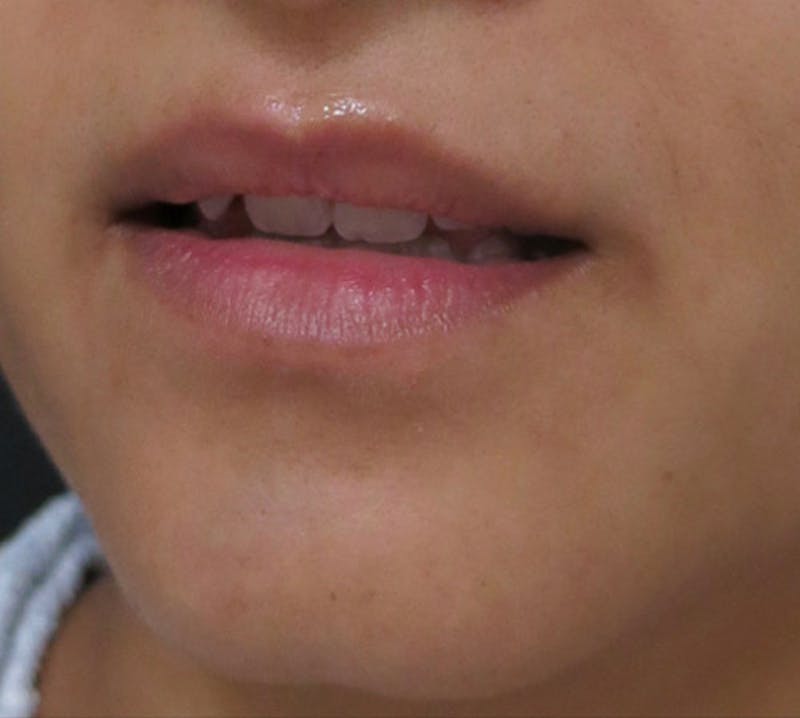 Lip Augmentation Before & After Gallery - Patient 122909221 - Image 7