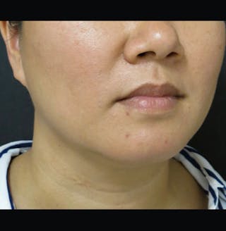 Non-Surgical Neck Lift Before & After Gallery - Patient 122909220 - Image 10