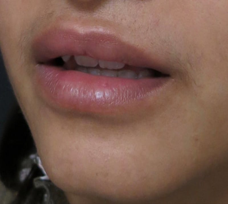 Lip Augmentation Before & After Gallery - Patient 122909221 - Image 8