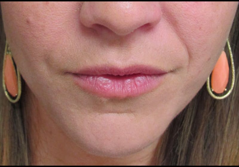 Lip Augmentation Before & After Gallery - Patient 122909222 - Image 1
