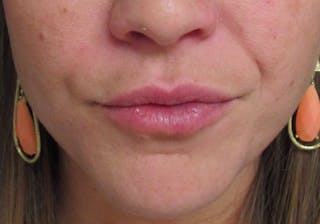 Lip Augmentation Before & After Gallery - Patient 122909222 - Image 2