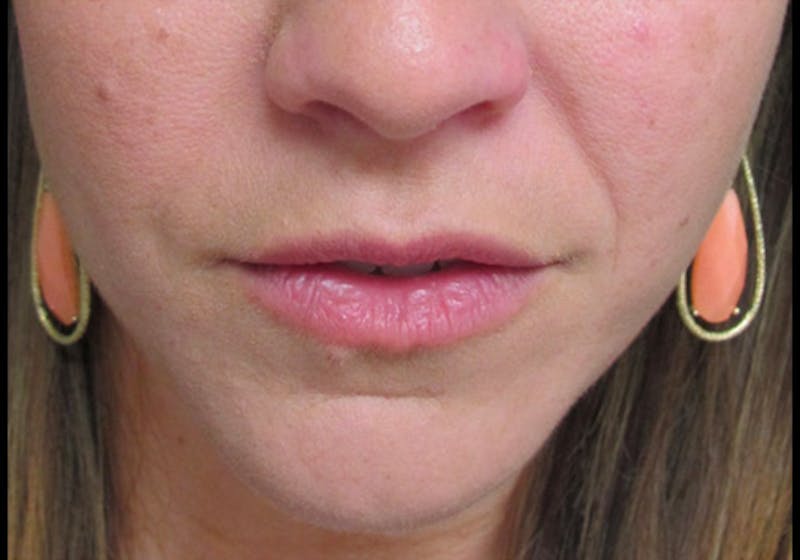 Lip Augmentation Before & After Gallery - Patient 122909222 - Image 3
