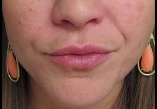 Lip Augmentation Before & After Gallery - Patient 122909222 - Image 4