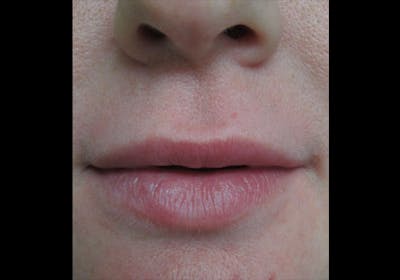 Lip Augmentation Before & After Gallery - Patient 122909228 - Image 1