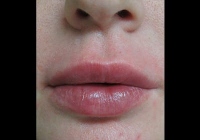 Lip Augmentation Before & After Gallery - Patient 122909228 - Image 2