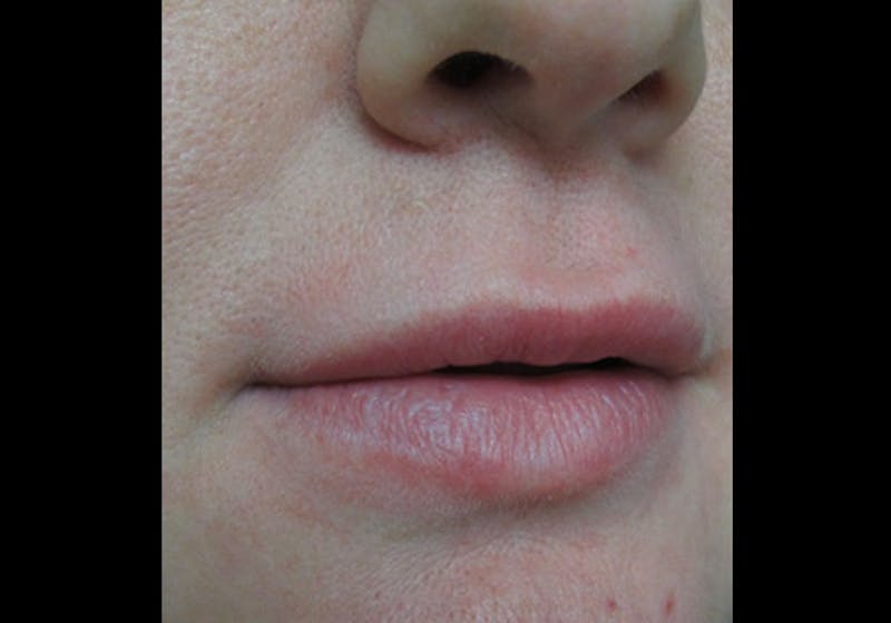 Lip Augmentation Before & After Gallery - Patient 122909228 - Image 3