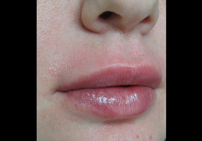Lip Augmentation Before & After Gallery - Patient 122909228 - Image 4