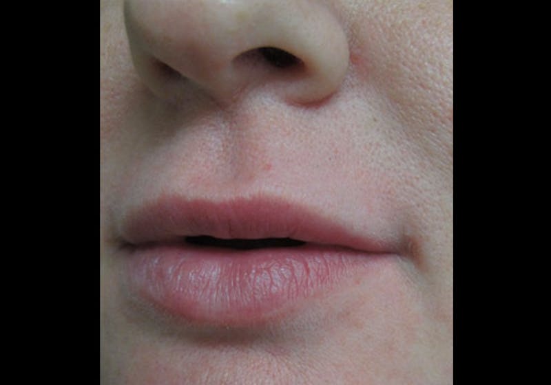 Lip Augmentation Before & After Gallery - Patient 122909228 - Image 5