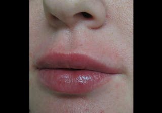 Lip Augmentation Before & After Gallery - Patient 122909228 - Image 6