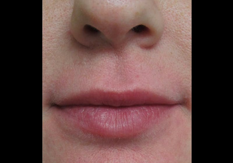 Lip Augmentation Before & After Gallery - Patient 122909228 - Image 7