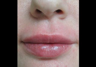 Lip Augmentation Before & After Gallery - Patient 122909228 - Image 8