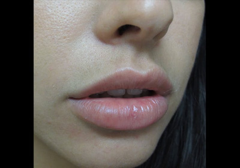 Lip Augmentation Before & After Gallery - Patient 122909239 - Image 1