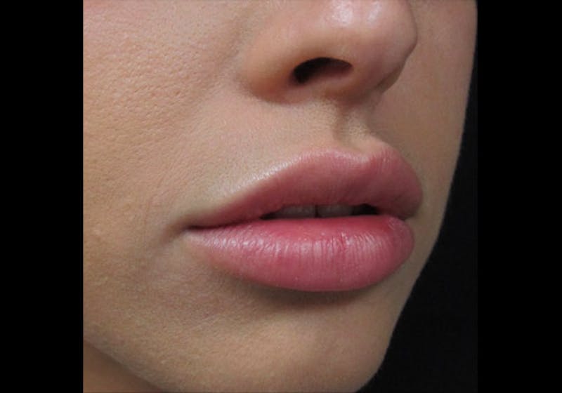 Lip Augmentation Before & After Gallery - Patient 122909239 - Image 2