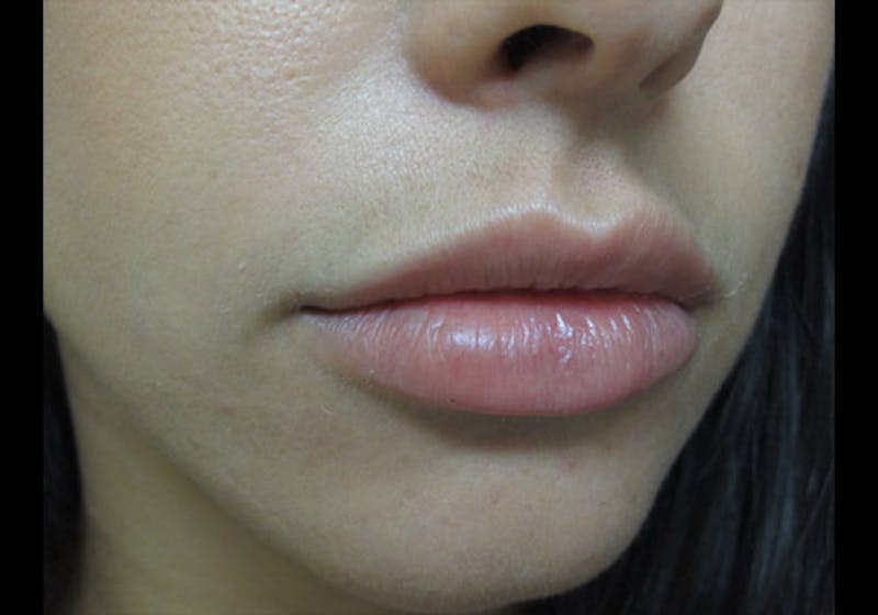 Lip Augmentation Before & After Gallery - Patient 122909239 - Image 3