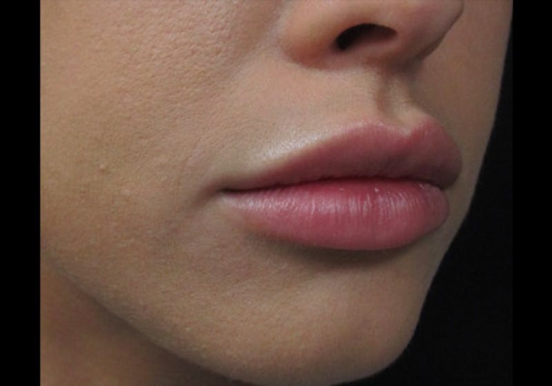 Lip Augmentation Before & After Gallery - Patient 122909239 - Image 4