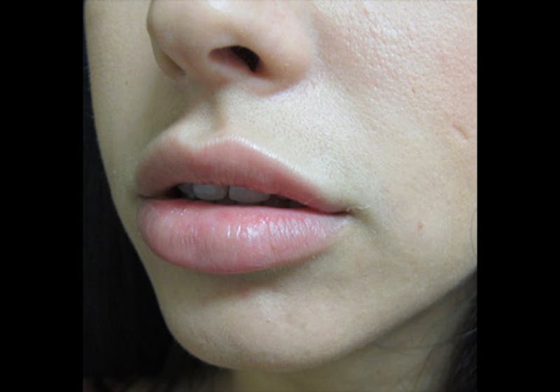 Lip Augmentation Before & After Gallery - Patient 122909239 - Image 5