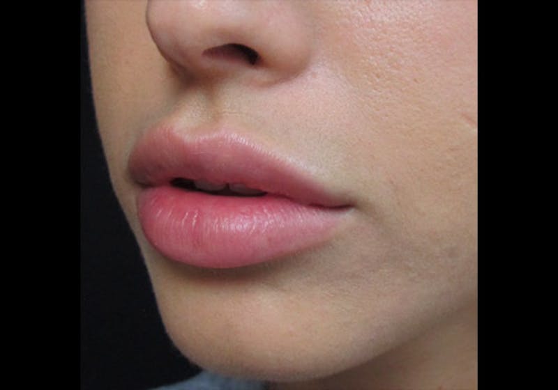 Lip Augmentation Before & After Gallery - Patient 122909239 - Image 6
