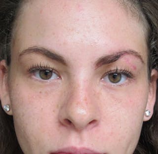 Laceration Repair Before & After Gallery - Patient 122909237 - Image 2