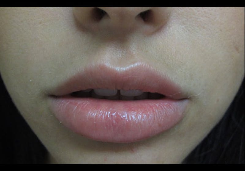 Lip Augmentation Before & After Gallery - Patient 122909239 - Image 7