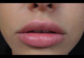 Lip Augmentation Before & After Gallery - Patient 122909239 - Image 8
