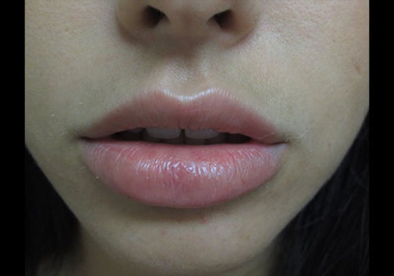 Lip Augmentation Before & After Gallery - Patient 122909239 - Image 9