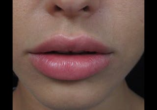 Lip Augmentation Before & After Gallery - Patient 122909239 - Image 10