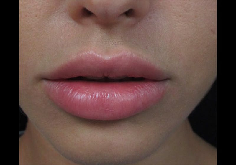 Lip Augmentation Before & After Gallery - Patient 122909239 - Image 10