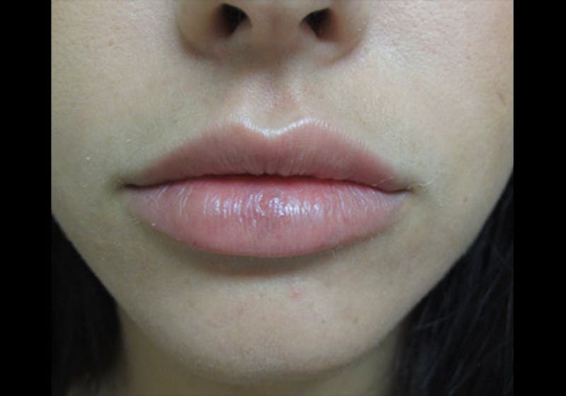 Lip Augmentation Before & After Gallery - Patient 122909239 - Image 11