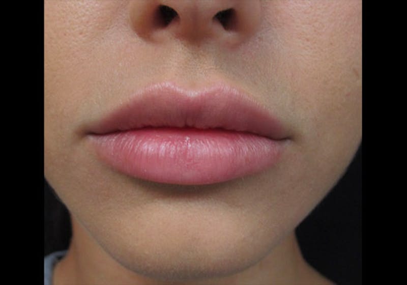 Lip Augmentation Before & After Gallery - Patient 122909239 - Image 12
