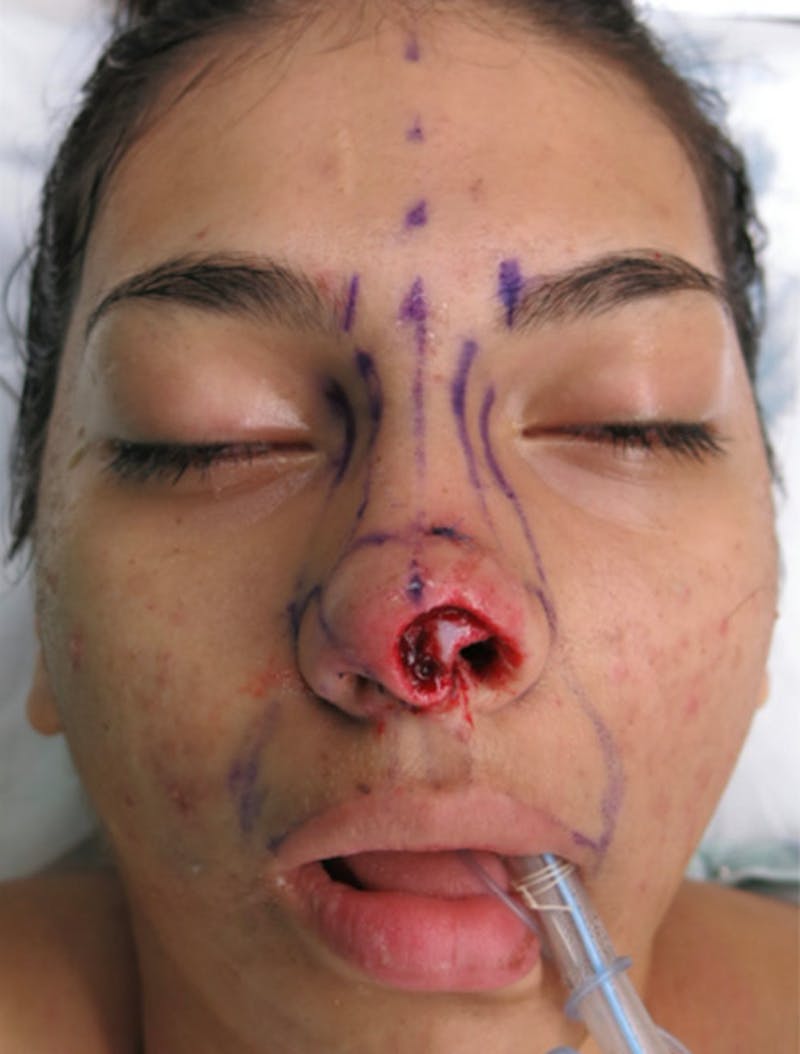 Laceration Repair Before & After Gallery - Patient 122909244 - Image 1