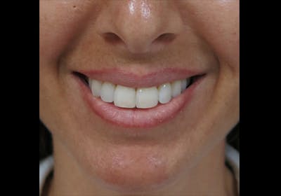Lip Augmentation Before & After Gallery - Patient 122909241 - Image 1