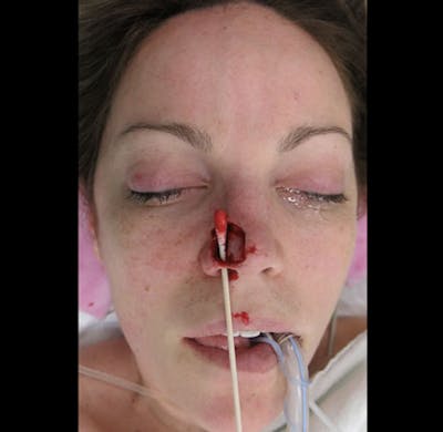 Nasal Reconstruction Before & After Gallery - Patient 122909242 - Image 1