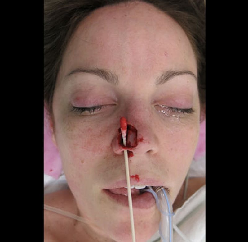 Nasal Reconstruction Before & After Gallery - Patient 122909242 - Image 1