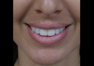Lip Augmentation Before & After Gallery - Patient 122909241 - Image 2