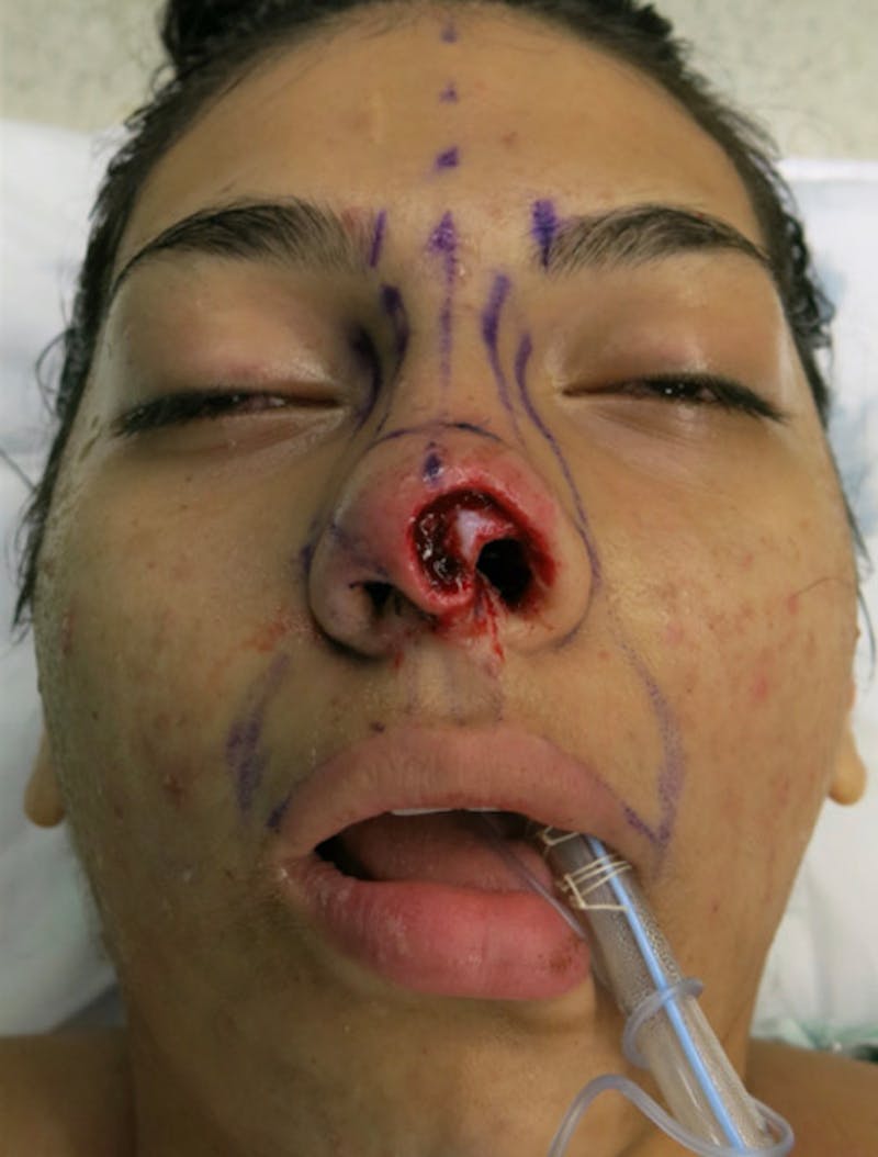Laceration Repair Before & After Gallery - Patient 122909244 - Image 3