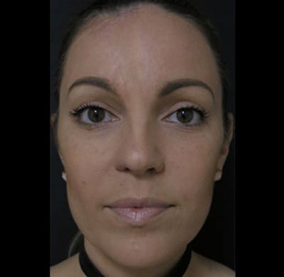 Nasal Reconstruction Before & After Gallery - Patient 122909242 - Image 2