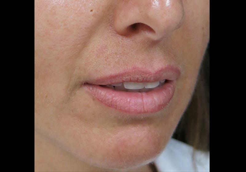 Lip Augmentation Before & After Gallery - Patient 122909241 - Image 3
