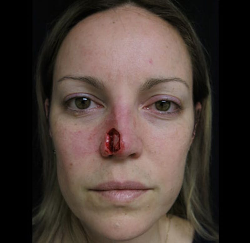 Nasal Reconstruction Before & After Gallery - Patient 122909242 - Image 3